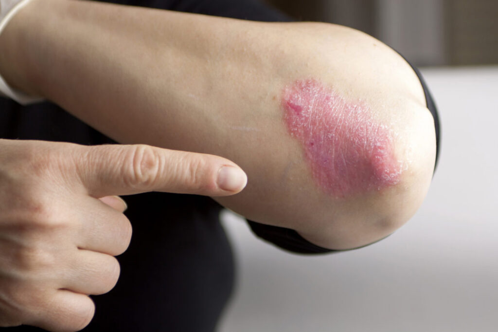 Iš pirmo žvilgsnio žvynelinė (psoriazė) daugeliui atrodo kaip liga, pasireiškianti tik kosmetinėmis problemomis. Tačiau ja sergantys pacientai susiduria su daug rimtesnėmis pasekmėmis. Lietuvoje apie 3 proc. gyventojų serga šia liga, tačiau jų gyvenimo kokybei trukdo ne tik sudėtingi simptomai, bet ir visuomenės priešiškumas.