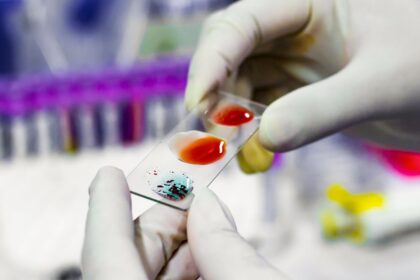 Mokslininkai įvardijo kraujo grupę, kurios atstovus dažniausiai ištinka ankstyvieji insultai – tai yra dar nesulaukus nė šešiasdešimties metų.